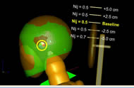 Figure three displays the MADYMO simulation model head and wheelchair-mounted headrest. Five headrest positions are displayed with corresponding neck injury criteria vales. Headrest positions are varied vertically. All headrest positions have the same Nij value with the exception of the lowest position, which is higher. 